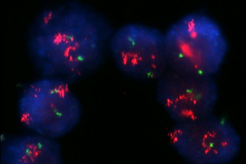 A case of HER-2-positive recurrent breast cancer showing a clinically complete response to trastuzumab-containing chemotherapy after primary treatment of triple-negative breast cancer Fluorescence in situ hybridization (FISH) analysis of the lymph node metastasis showed strong HER2 amplification in most cells, with a FISH ratio of 5.6.