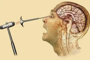 Lobotomy