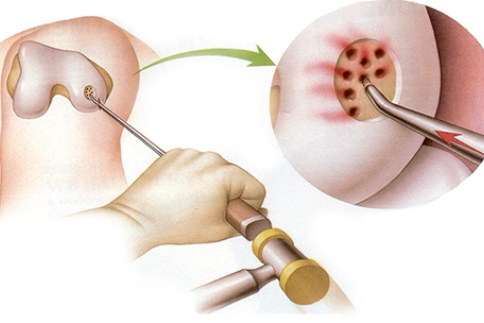Microfracture surgery