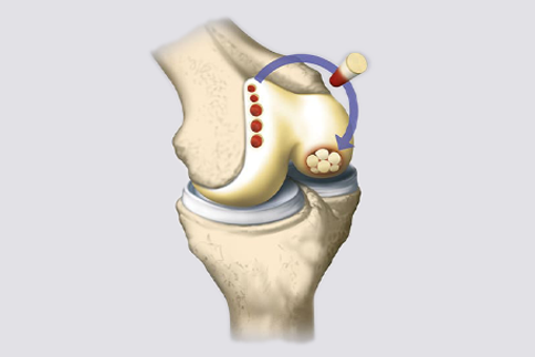 Oats surgery
